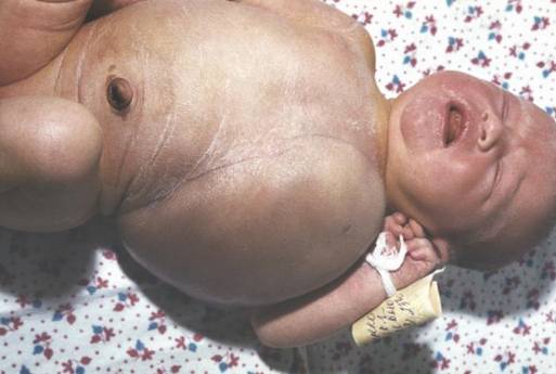 рис. 7. гигантская лимфангиома грудной клетки у ребенка.