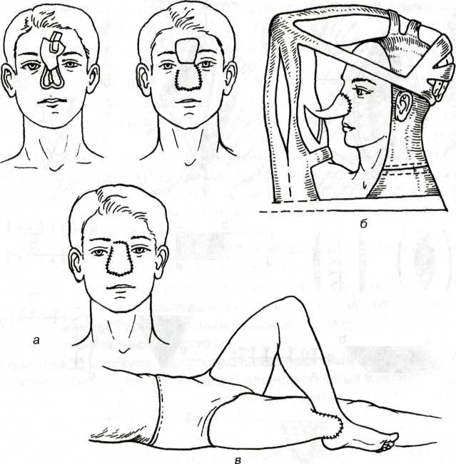 Кожная пластика кожным лоскутом. Кожная пластика Филатовский стебель. Пластика мостовидным лоскутом метод Склифосовского. Пластика лоскутом на питающей ножке ЧЛХ. Несвободная пластика кожи хирургия.