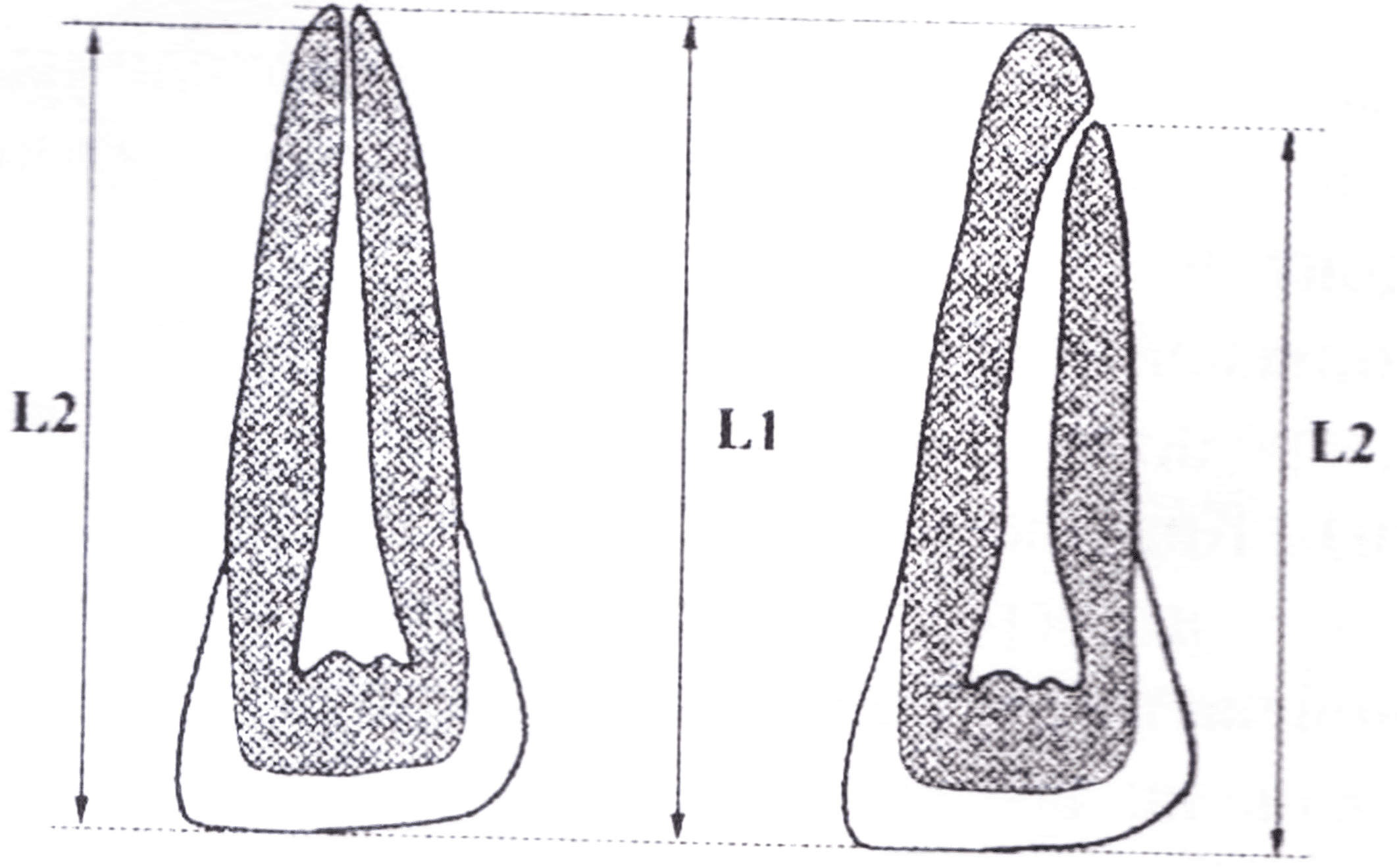 Определение корневых каналов. Рабочая длина корневого канала. Рабочая длина зуба. Рабочая и анатомическая длина зуба. Рабочая длина канала зуба.