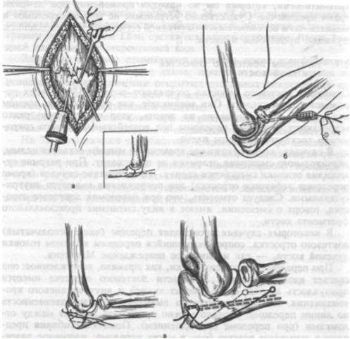 Операция перелом локтевого отростка. Операция по Веберу локтевой отросток. Перелом локтевого отростка. Перелом локтевого отростка остеосинтез. Остеосинтез перелома локтевого отростка по Веберу.