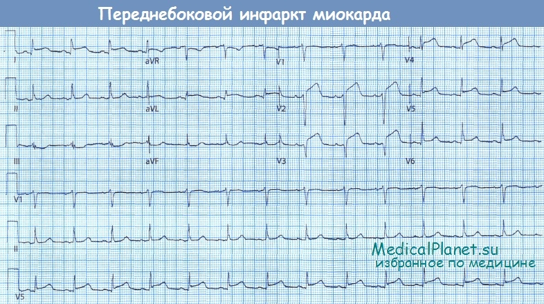 Окс передней стенки