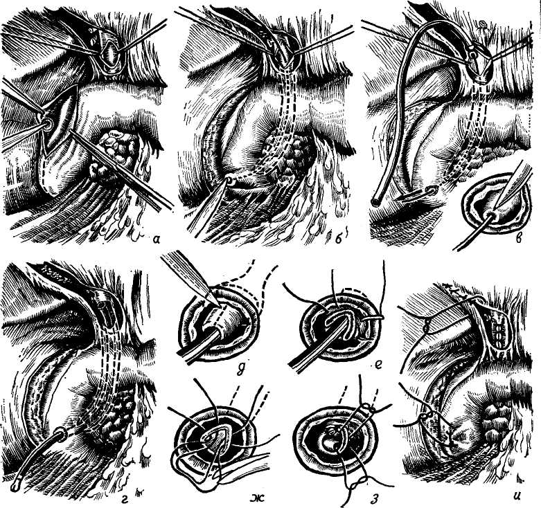 Лечение свища прямой кишки операция. Экстрасфинктерный свищ прямой кишки. Парапроктит операция Габриэля. Трансдуоденальная папиллосфинктеротомия это.