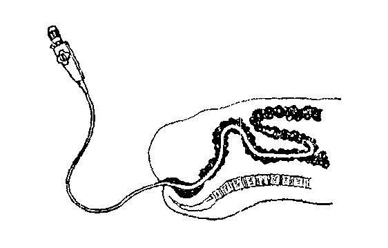 Путь продвижения эндоскопа при колоноскопии рисунок