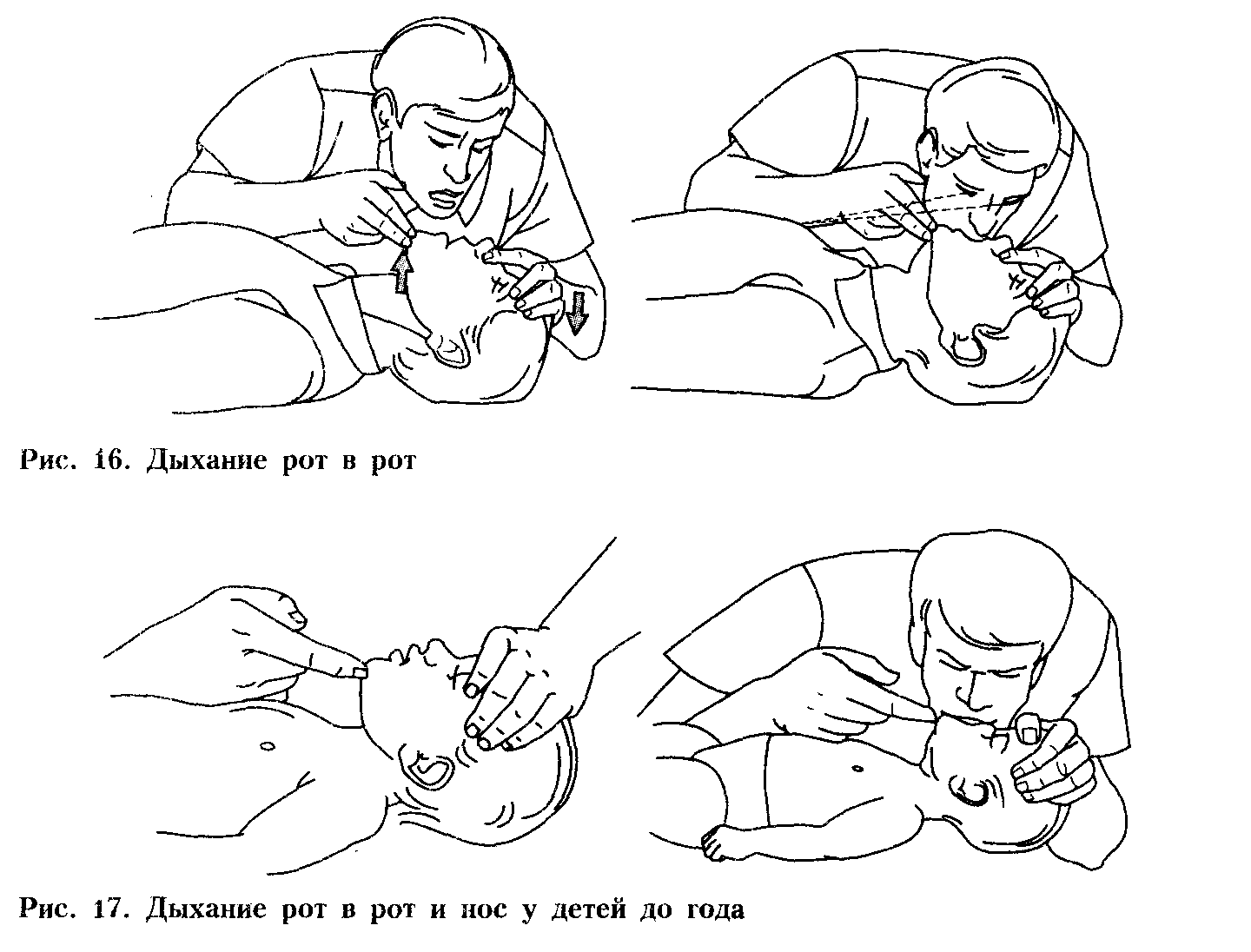 Проведение дыхательной реанимации. Схема проведения СЛР младенцу. Техника искусственного дыхания у детей. Искусственное дыхание изо рта в рот/нос. Непрямой массаж сердца.. Реанимация при остановке дыхания у ребенка.