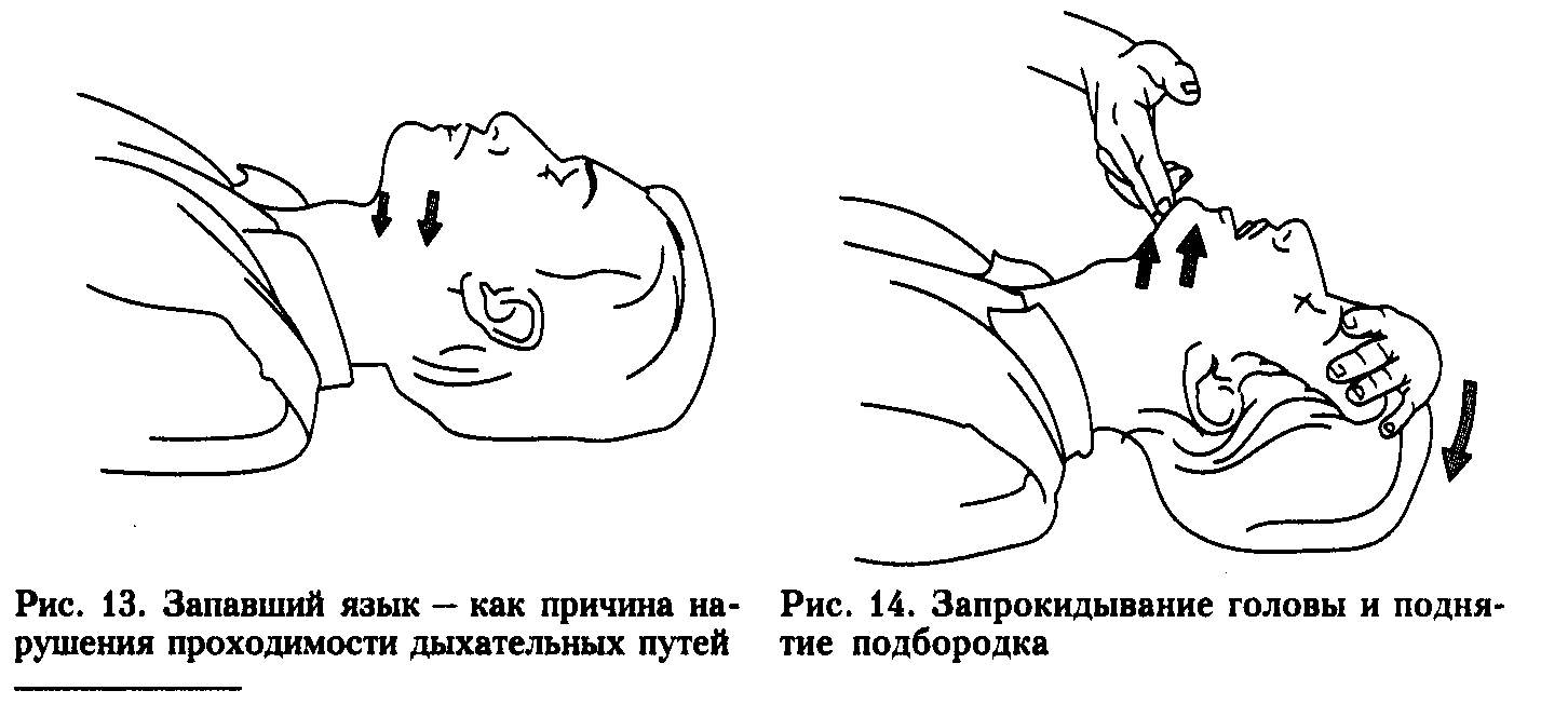 Запрокинуть голову с подъемом подбородка. Сердечно легочная реанимация запрокидывание головы. Освобождение дыхательных путей при СЛР. Запрокидывание головы при сердечно-легочной реанимации. Обеспечение проходимости дыхательных путей СЛР.