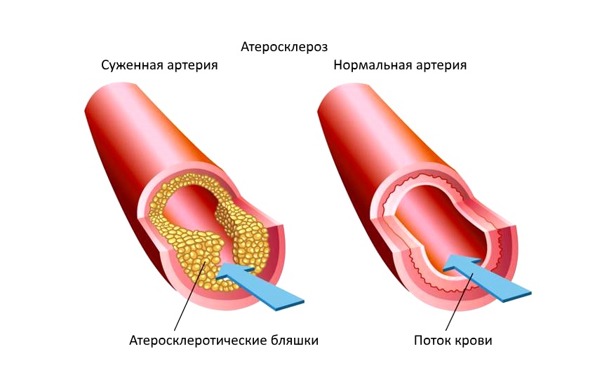 Атеросклероз со. Стадии атеросклероза коронарных артерий. Атеросклероз фиброзные бляшки. Стадии образования Блашка атеросклероз. Схема образования атеросклеротической бляшки.