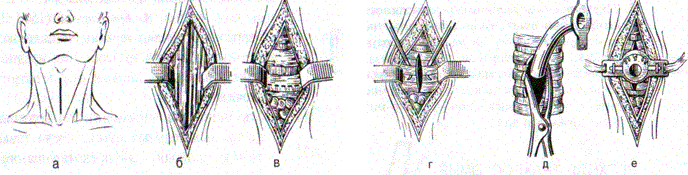 Наложение трахеостомы. Трахеостомия Оперативная хирургия. Трахеотомия и трахеостомия. Трахеостомия техника операции.