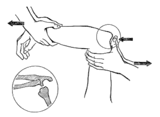 вправление вывиха предплечья