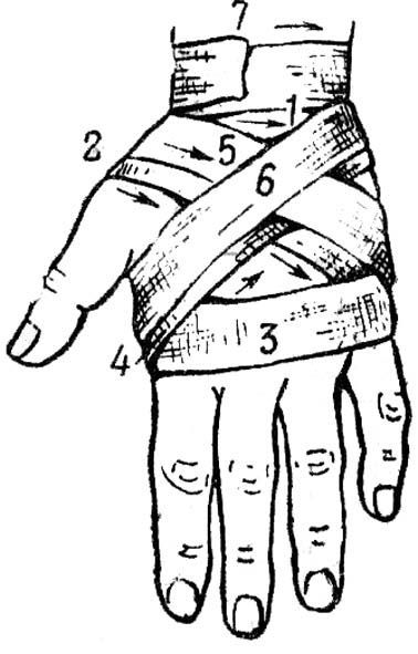 Повязка на кисть. Восьмиобразная повязка на лучезапястный сустав. Крестообразная (восьмиобразная) повязка на кисть. Наложение восьмиобразной повязки на кисть. Наложение повязки на кисть (крестообразная повязка).