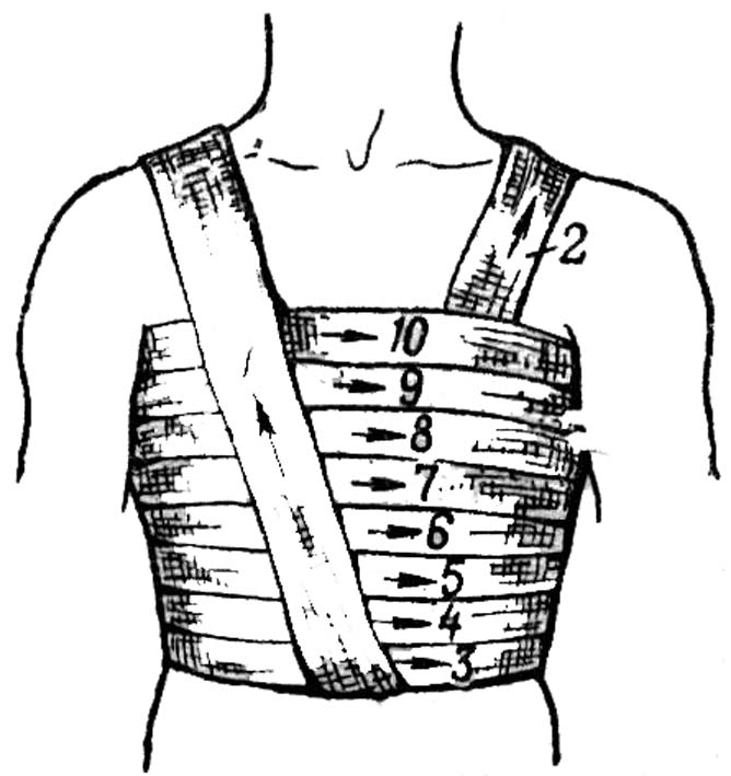 Повязки на туловище. Наложение спиральной повязки на грудную клетку. Наложение бинтовой повязки на грудную клетку. Перевязка спиральная на грудную клетку. Спиральная повязка на грудную клетку с портупеей.