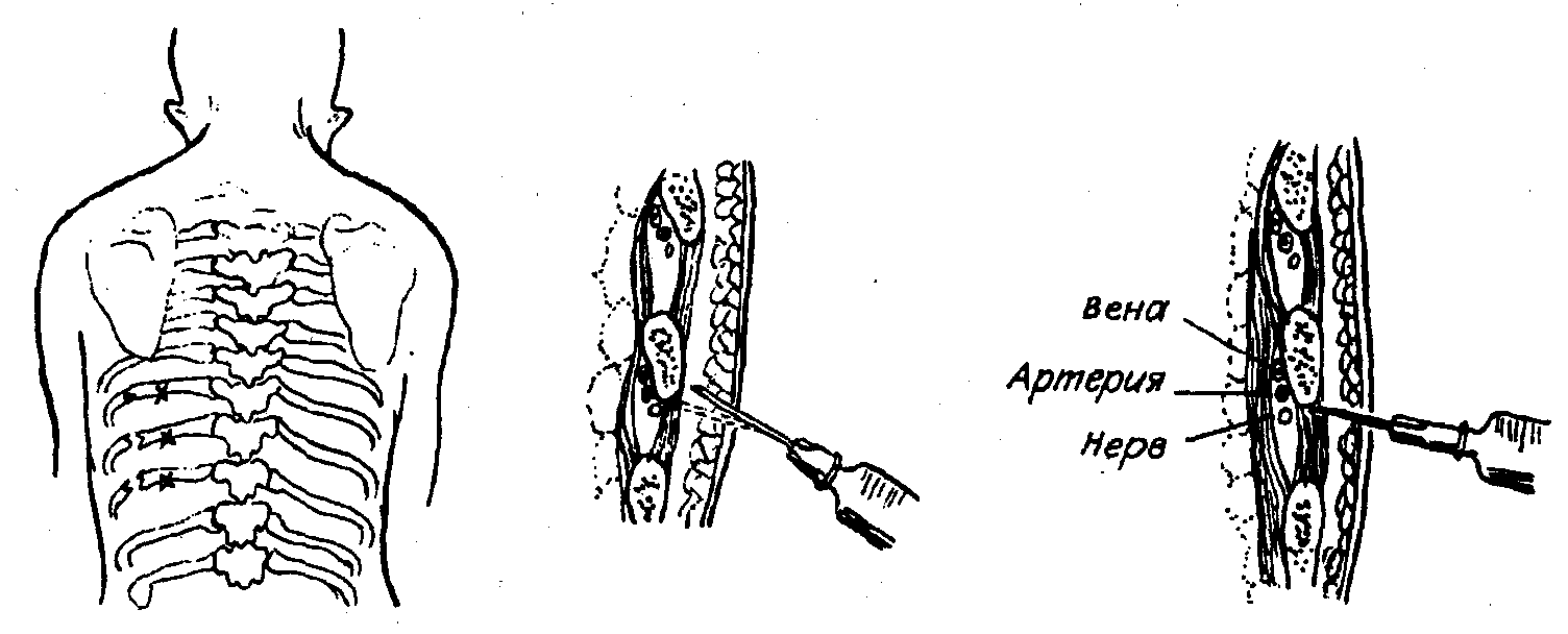 Блокады при переломах. Межреберная новокаиновая блокада. Межреберная проводниковая анестезия. Паравертебральная блокада межреберных нервов. Межреберная блокада техника.