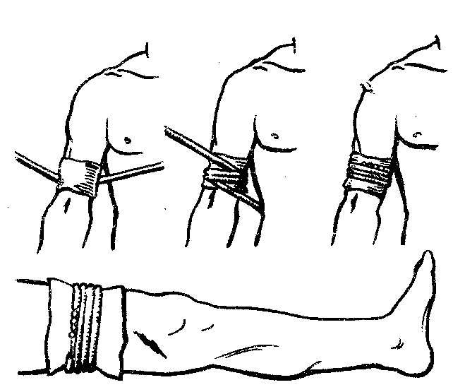 Жгут и шину можно использовать при повреждении