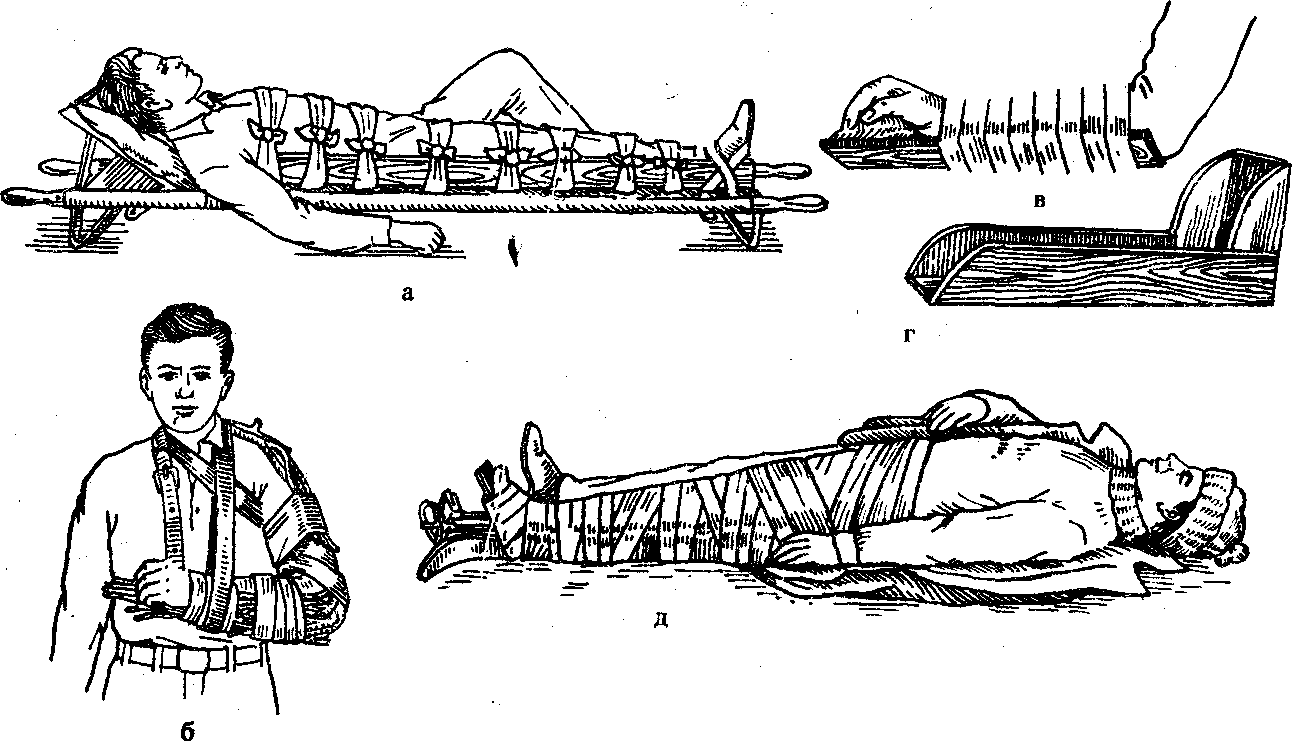 Соотнесите варианты иммобилизации показанные на рисунке с видами травм