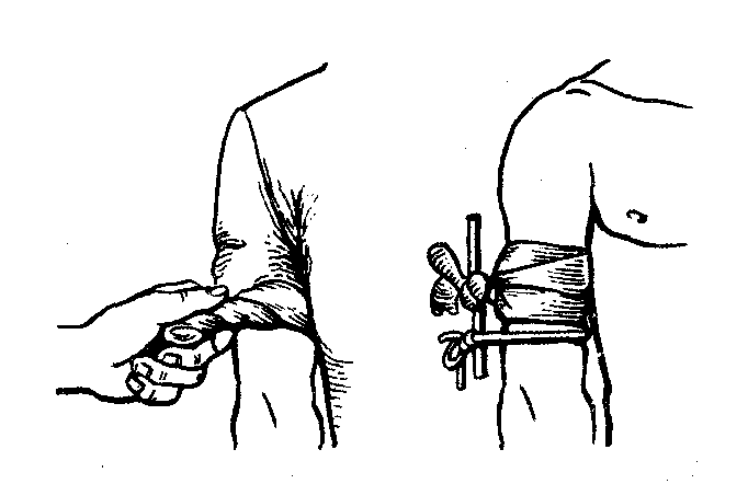 Вместо жгута можно использовать давящую повязку. Наложение жгута косынкой. Наложение давящей повязки.