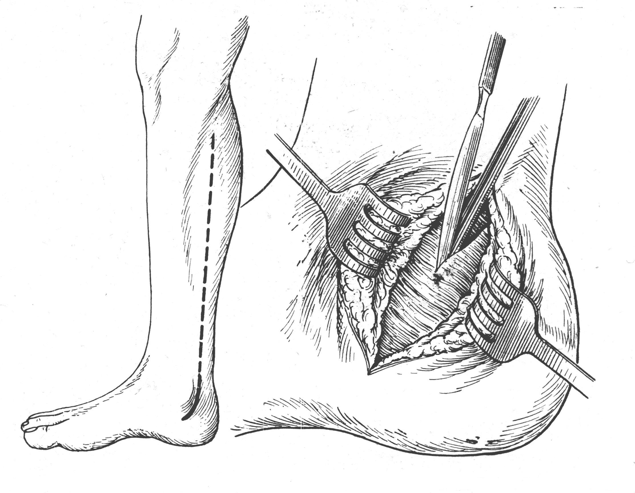 Ампутации топографическая анатомия. Доступ к задней большеберцовой артерии. Перевязка передней большеберцовой артерии в средней трети. Обнажение задней большеберцовой артерии. Проекционные линии передней и задней большеберцовых артерий.
