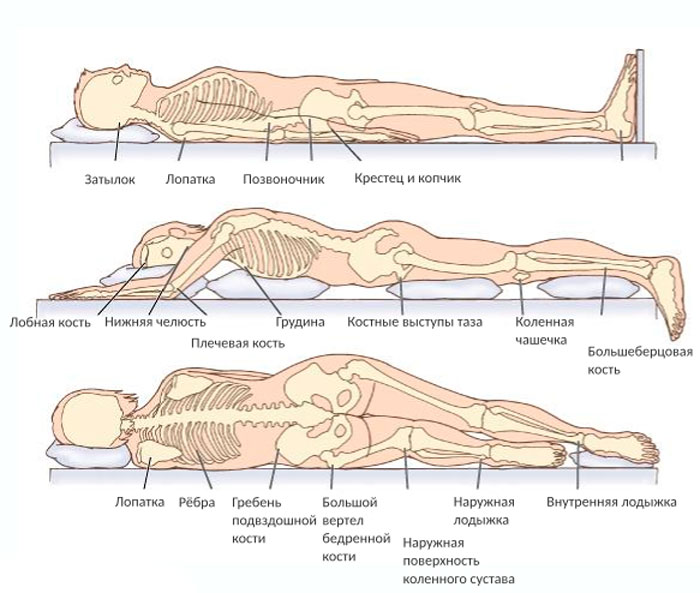 Лежать костями. Места образования пролежней у пациента лежащего на спине. Зоны риска образования пролежней. Пролежни места образования профилактика. Места образования пролежней лежа на боку.