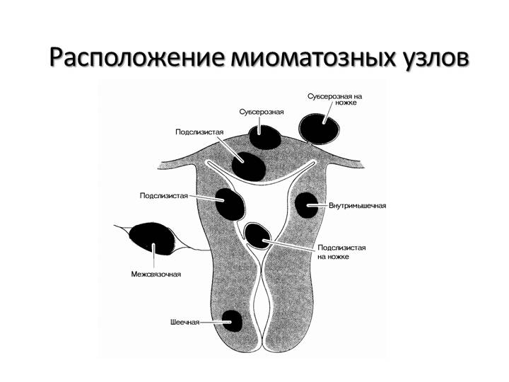 Фиго миома. Классификация миом матки по УЗИ. Миоматозный узел некроз. Нарушение кровоснабжения миоматозного узла. Центрипетальный рост миоматозного узла.