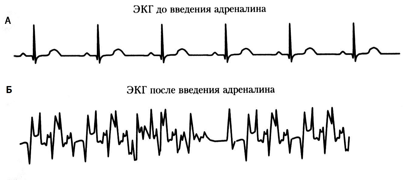 Давление при выбросе адреналина. Действие адренал на на сердце. ЭКГ после адреналина. На ЭКГ после введения адреналина. Кардиограмма сердца при адреналине.