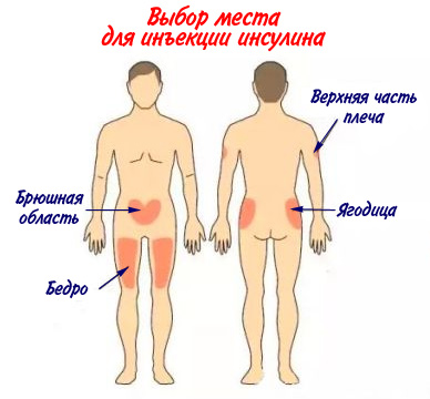 Место введения. Места инъекции инсулина при диабете. Места укола инсулина при диабете. Зоны введения инсулина диабетикам. Места инъекции инсулина при диабете 1 типа.