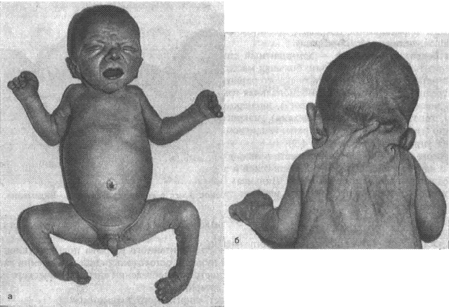 картинки по запросу синдром марфана у новорожденных