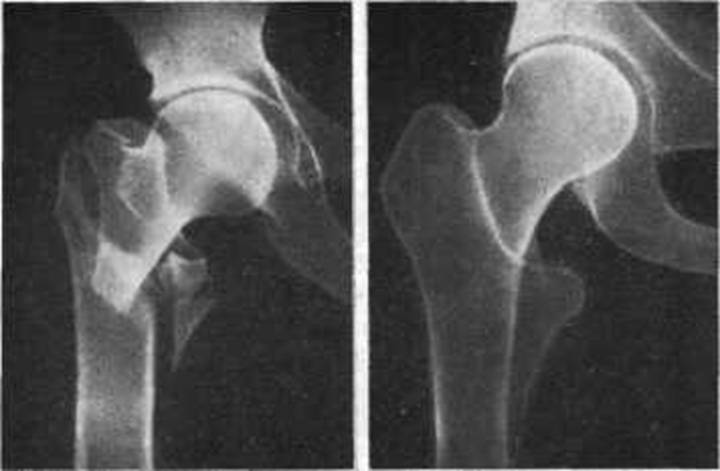 Перелом бедра лечение без операции. Чрезвертельный перелом бедренной кости рентген. Вколоченный перелом шейки бедра рентген. Вколоченный перелом шейки бедра. Межвертельный перелом бедренной кости рентген.