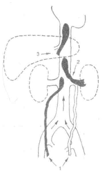Тромб полой вены. Инфраренальный отдел нижней полой вены. Инфраренальный сегмент нижней полой вены. Флотирующий тромб нижней полой вены. Тромбоз в нижней полой Вене.