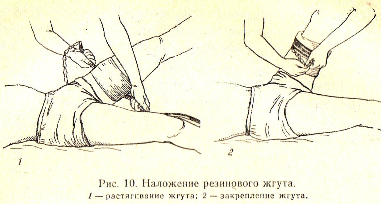 Накладывание жгута картинка