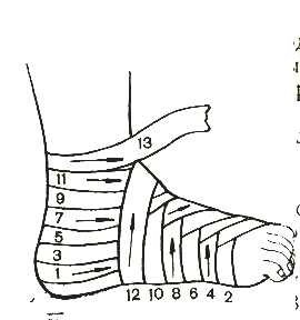 Как завязывать голеностоп. Колосовидная повязка на стопу алгоритм. Перевязка колосовидная на предплечье. Десмургия повязка восьмиобразная на голеностопный сустав. Колосовидная повязка на голеностопный сустав.