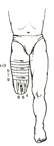 Повязка на культю алгоритм. Наложение повязки на культю алгоритм. Наложение повязки на культю бедра.