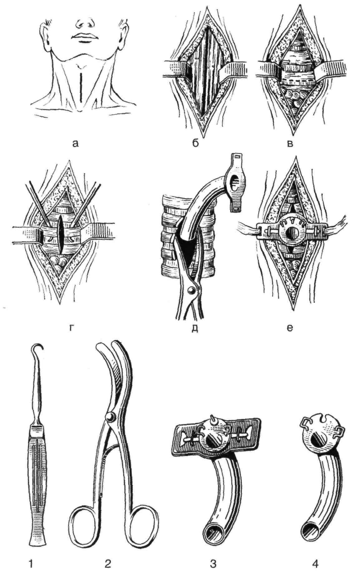 Наложение трахеостомы. Трахеотомия и трахеостомия. Инструменты для трахеостомии топографическая анатомия. Трахеотомия топографическая анатомия.