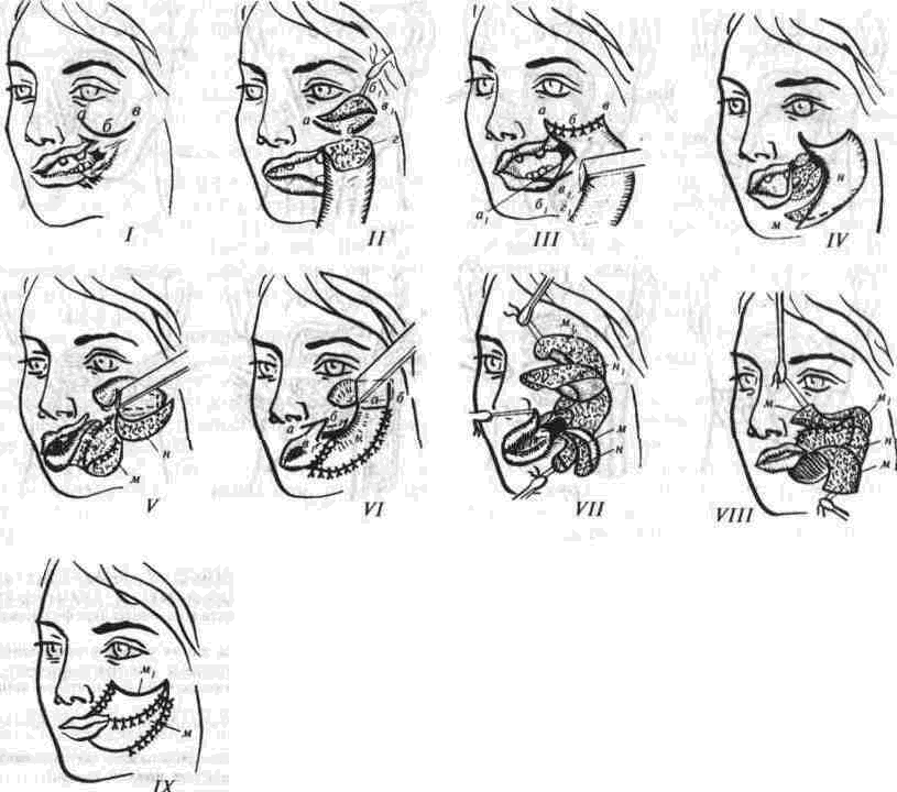 Восстановительная операция латынь. Схема деформации лица. Рисунок искривленное лицо. Восстановительная хирургия лица.