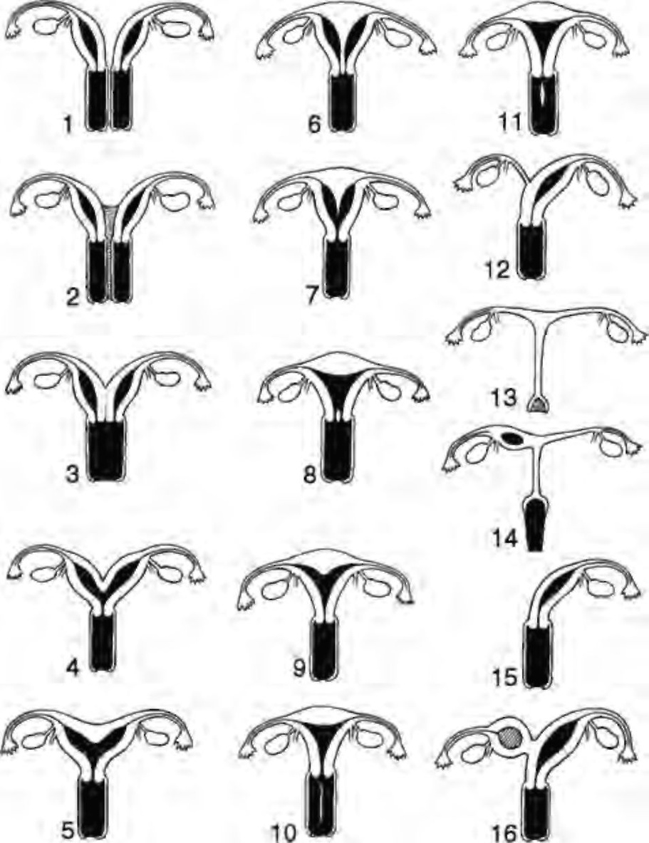 Разновидности половых губ у женщин. Аномалии развития матки. Аномалии формы матки классификация. Аномалия развития матки удвоение. Формы женских половых.