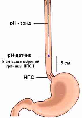 Высокий верхний. РН метрия желудочного сока. PH метрия суточная желудка зонд. РН-метрическое исследование пищевода. PH метрия пищевода методика.