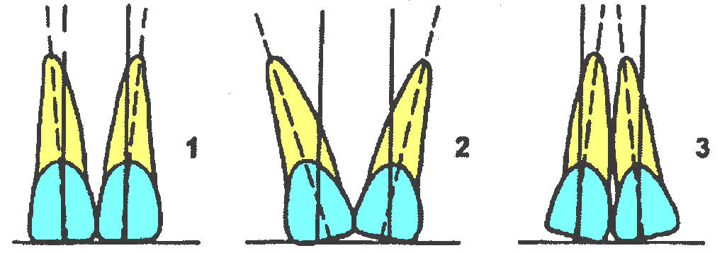 Ключ окклюзии. Ангуляция коронки зуба. Ангуляция инклинация торк. Мезиодистальный наклон коронок зубов. Ключи окклюзии ангуляция.