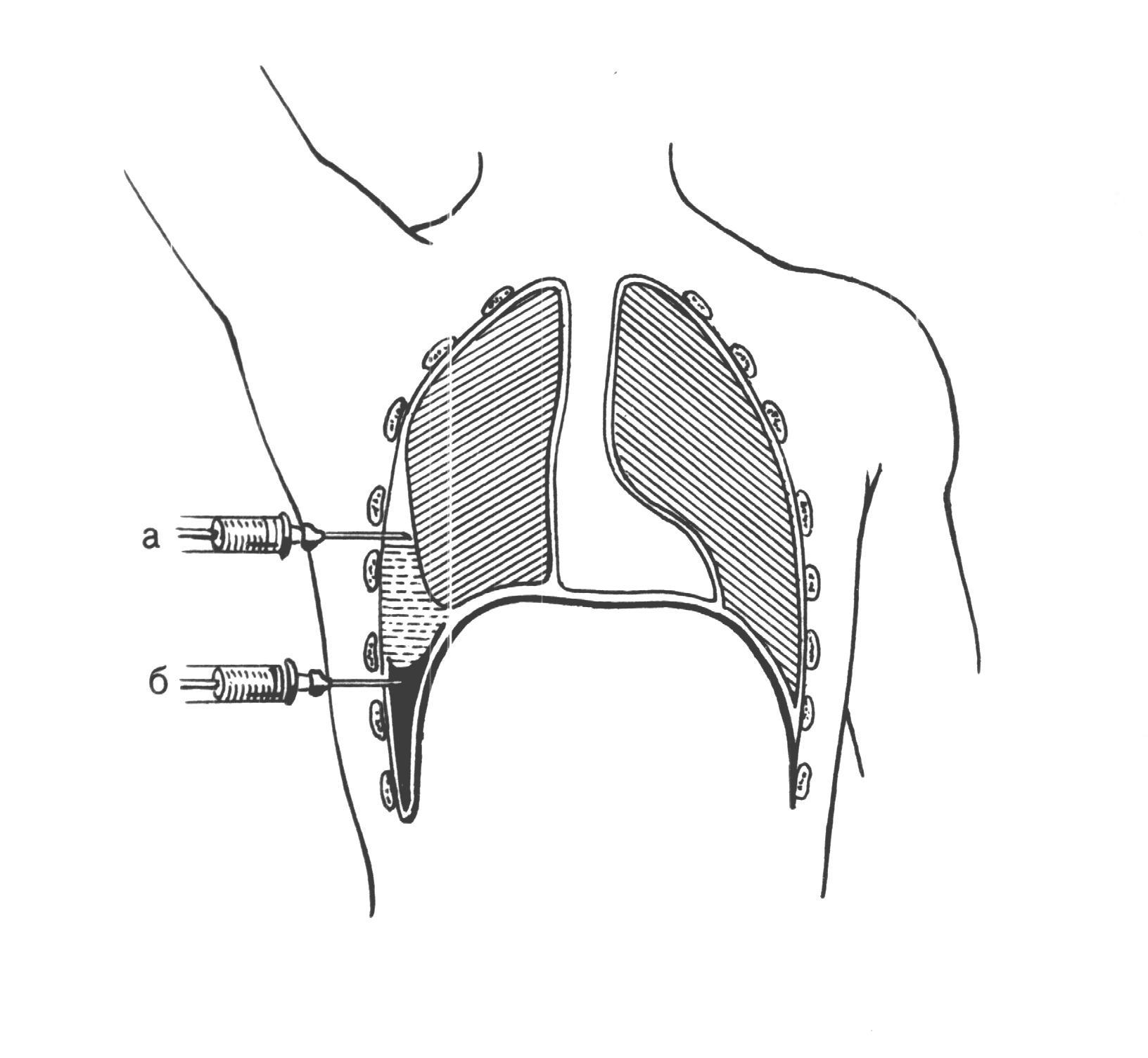Пункция полостей. Плевральная пункция межреберье. Пункция плевральной полости схема. Пункция при пневмотораксе и гидротораксе. Пункция плевральной полости при гидротораксе.
