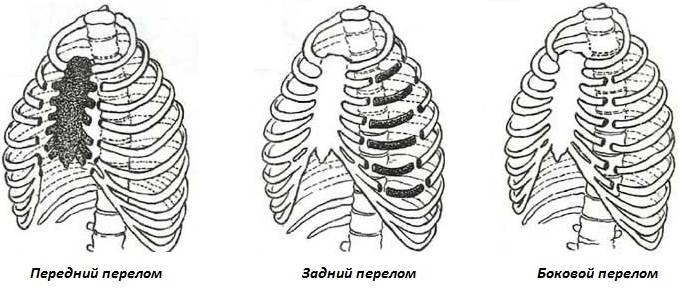 Можно сломать ребро при кашле