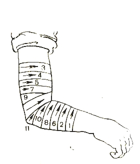 Спиральная повязка. Черепашья сходящаяся на локтевой сустав. Черепашья повязка на локтевой сустав. Перевязка локтя эластичным бинтом. Перевязка предплечья эластичным бинтом.