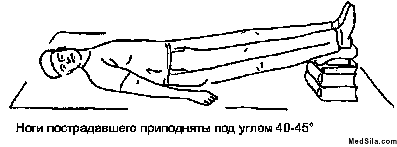 Горизонтальное положение рисунка. Положение с поднятыми ногами. Пострадавший на спине с приподнятыми ногами. Поднять ноги пострадавшего. Приподнять ноги пострадавшего.