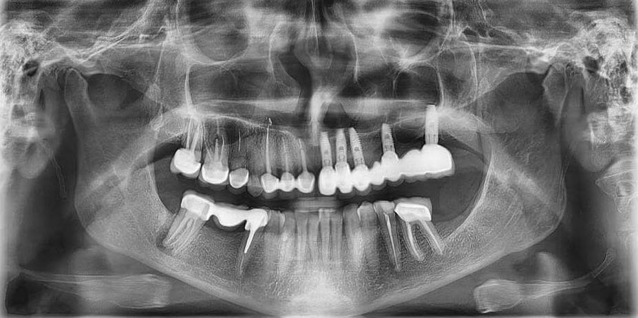 Оптг снимок. Ортопантомограмма челюсти. Снимок ортопантомограмма СПБ. Панорамный рентген зубов. Обзорная рентгенограмма зубов.